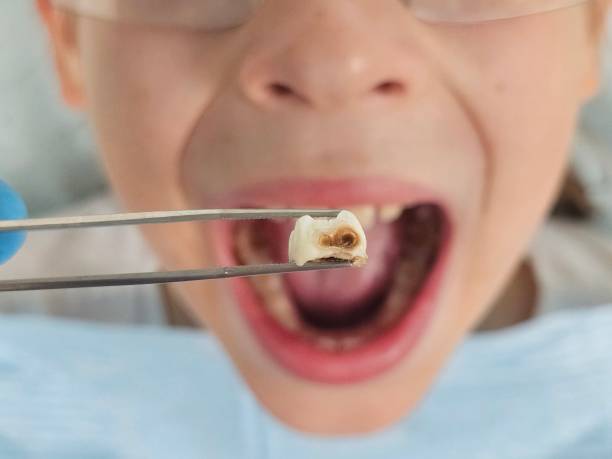 Best Emergency Tooth Extraction in Davenport, FL